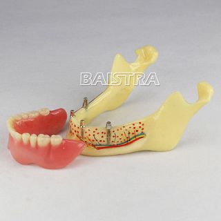 Dental teeth Implant model of the lower jaw for study and teach