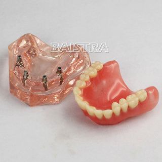 Dental overdenture inferior with 4 implants restoration teeth study 