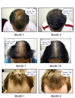 RETINOL A Hair Loss Treatment Cream (Retin ol) Use alone or with 