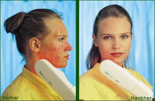 Syro Original BioBeam Acne Severe Acne Light Therapy Blemish Treatment 