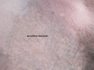  Chemical PEEL Wrinkle Remover Repair Acne Scar Sun Damaged FACIAL skin
